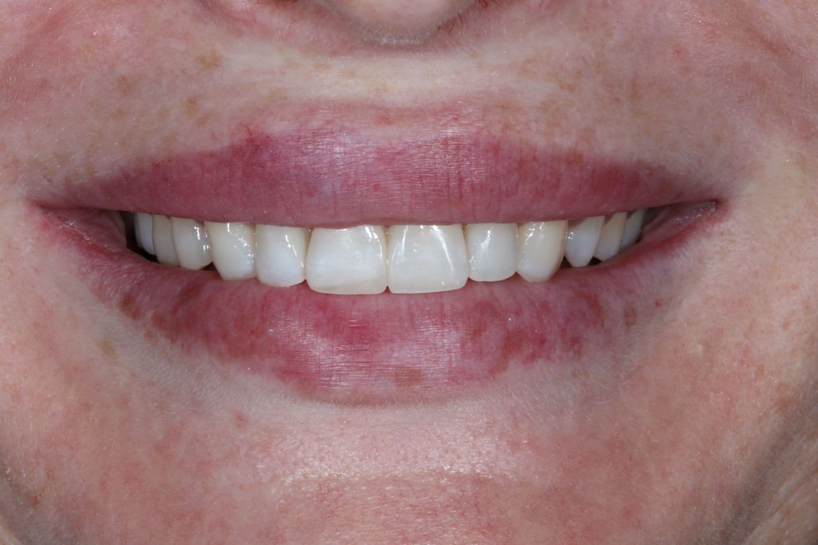 Cosmetic Veneers — After