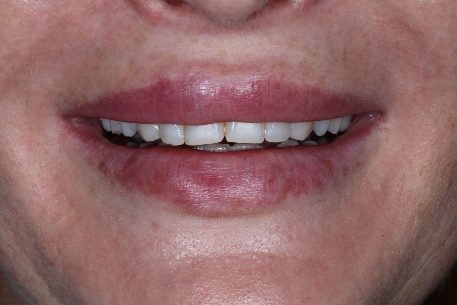 Cosmetic Veneers — Before