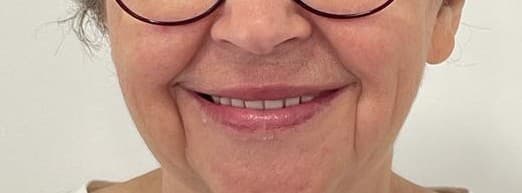 Full Smile Restoration — After