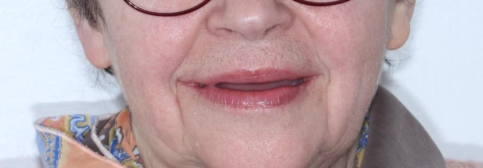 Full Smile Restoration — Before